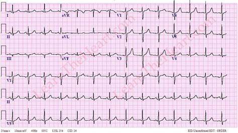 normal ecg 12 lead|normal 12 lead ecg tracing.
